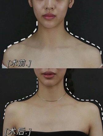 新2025澳门天天开好彩和女子打瘦肩针险丧命与有打过瘦肩针的美女吗