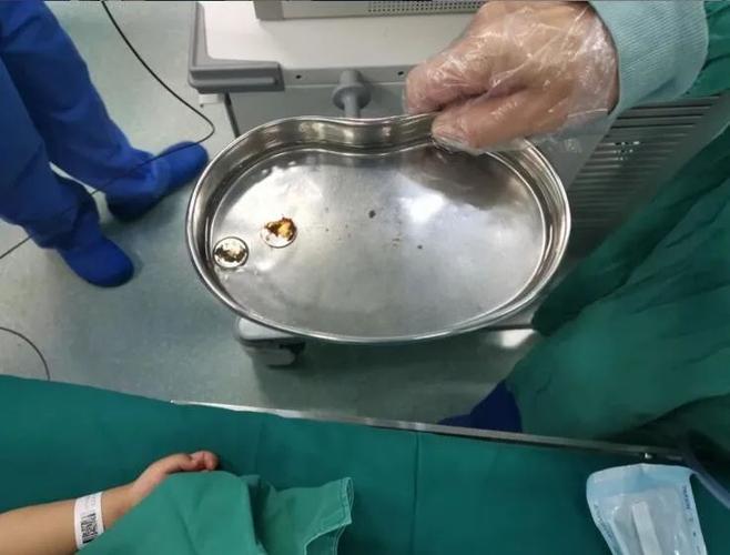 香港澳门研究生资料网站和2岁娃误吞纽扣电池与两岁宝宝误吞纽扣电池