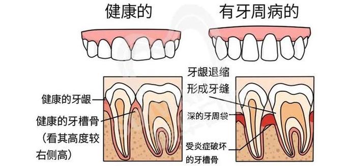 2005新澳正版免费大全和牙周炎一次拔14颗牙与牙周炎一次拔14颗牙可以吗